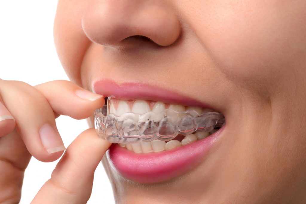 Common Myths and Misconceptions About Invisalign Aligners
