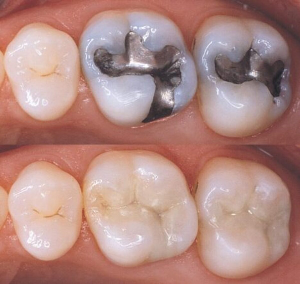 Composite Restorations: Exploring the Beauty of Blending with Your Natural Teeth