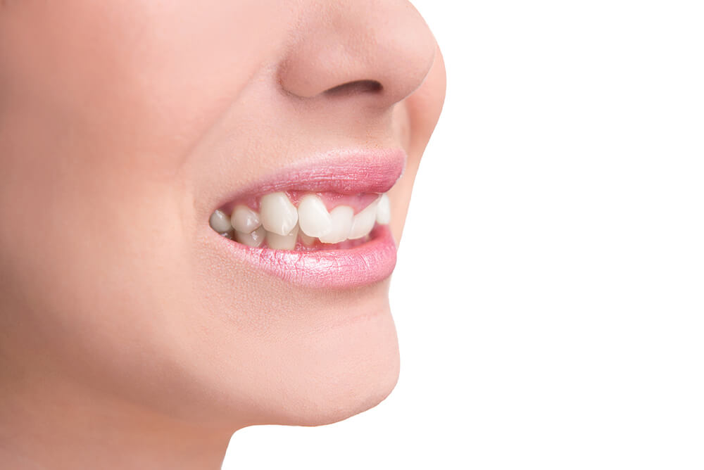 What is an Overbite, and How is it Treated? 